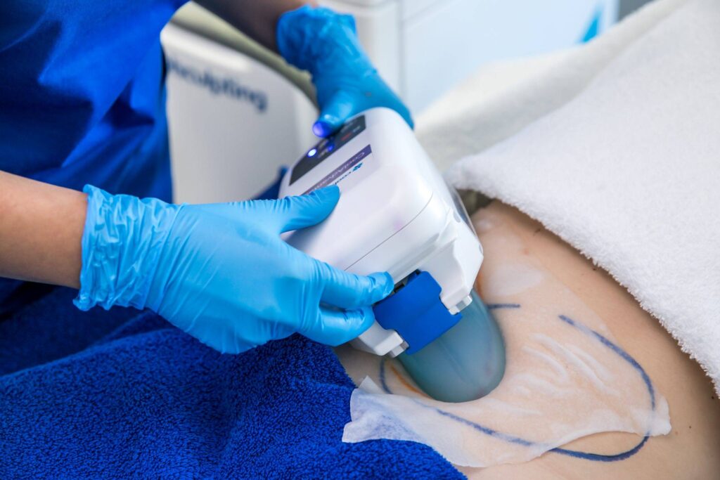 Can you freeze away your fat?
